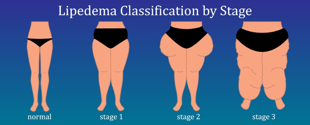 Differences Between Lymphedema And Lipedema Lipedema