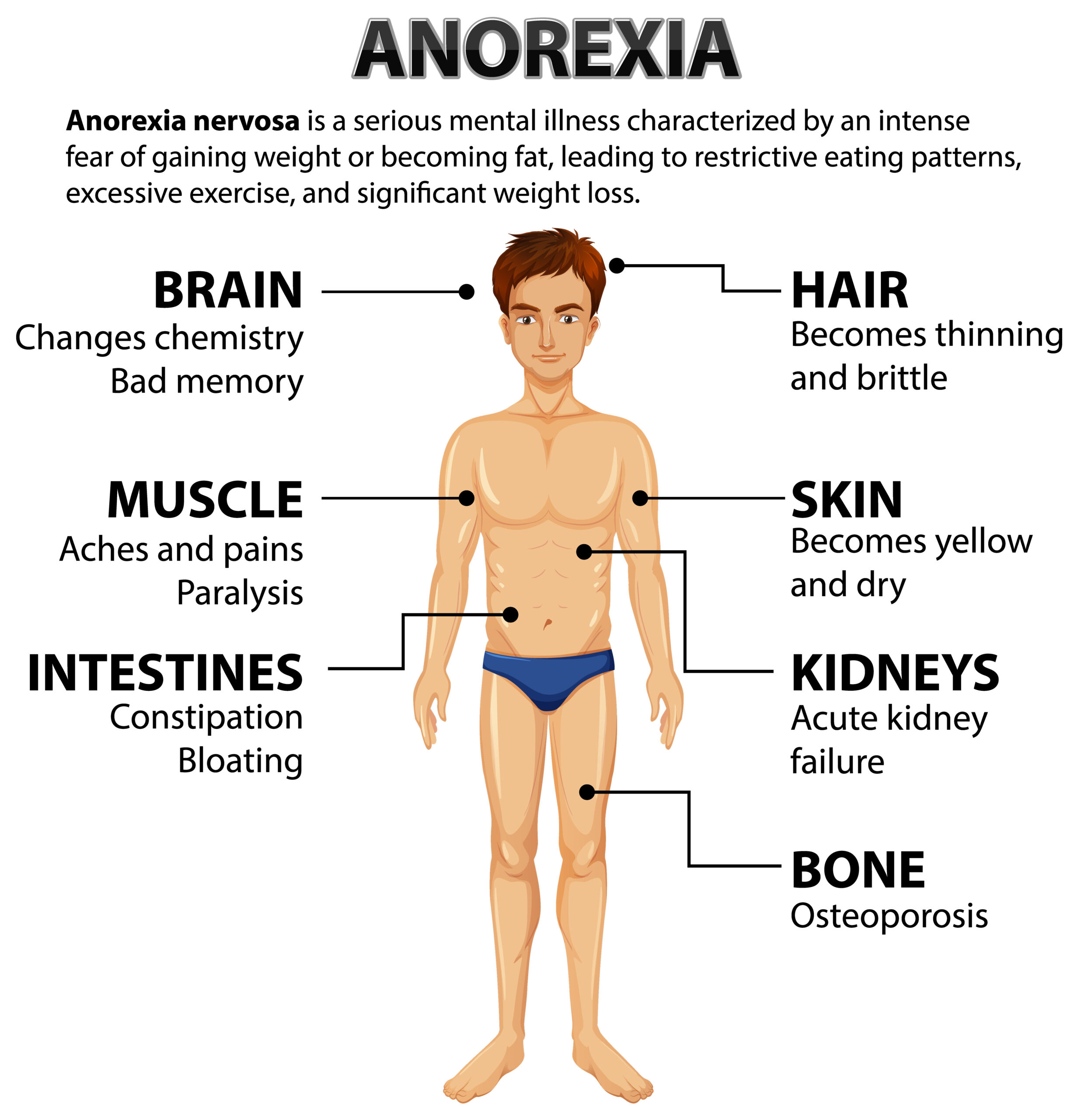 Anorexia and lipedema