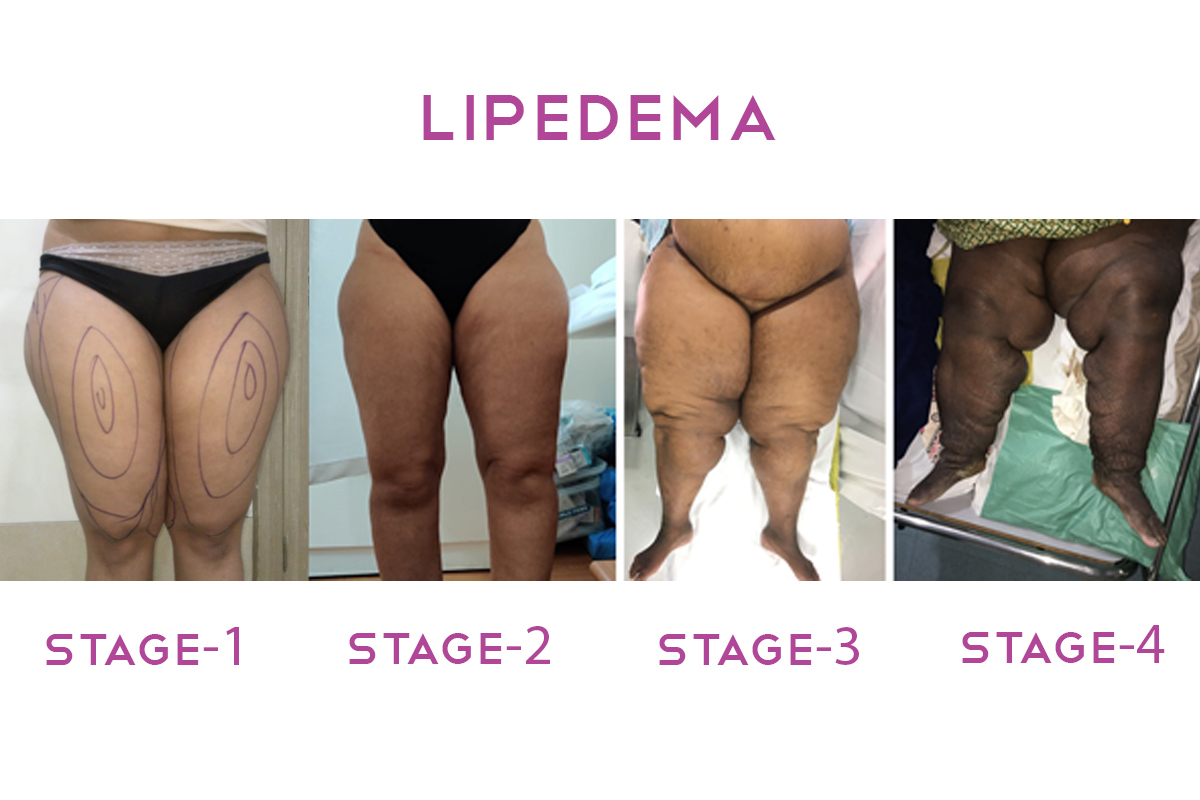 Lipedema Treatment Options What You Need To Know Lipedema