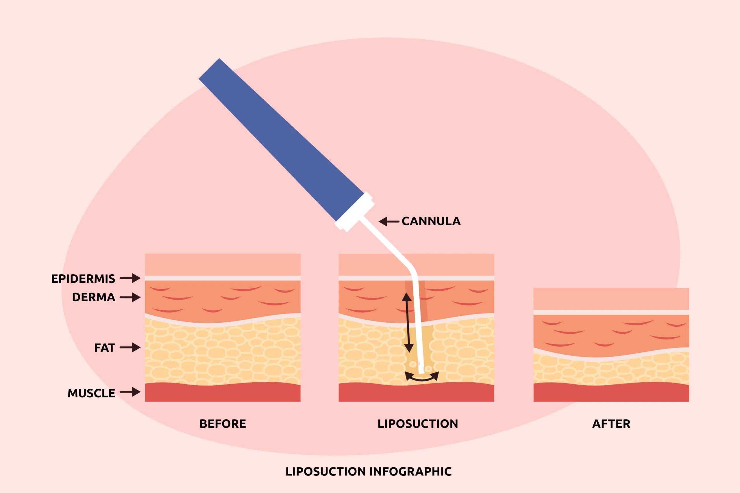 Lipedema progression after liposuction