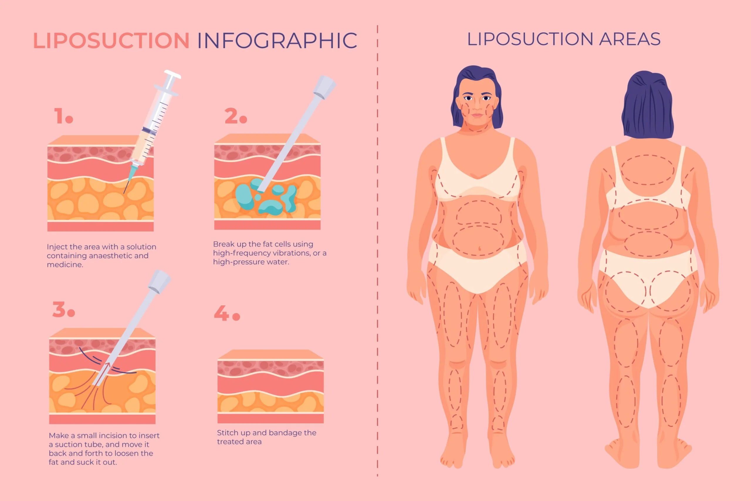 Role of surgery in lipedema
