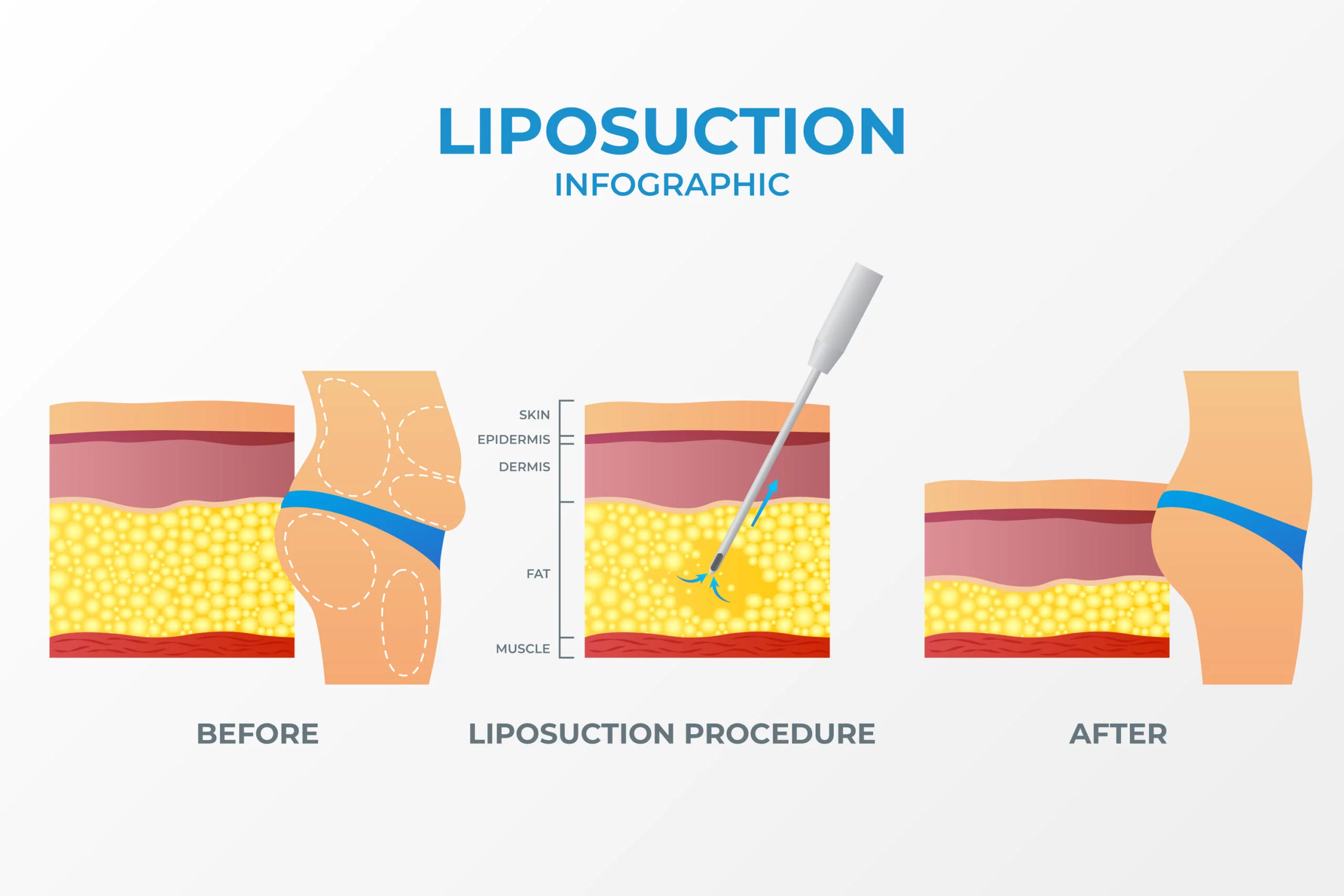 Role of surgery in lipedema