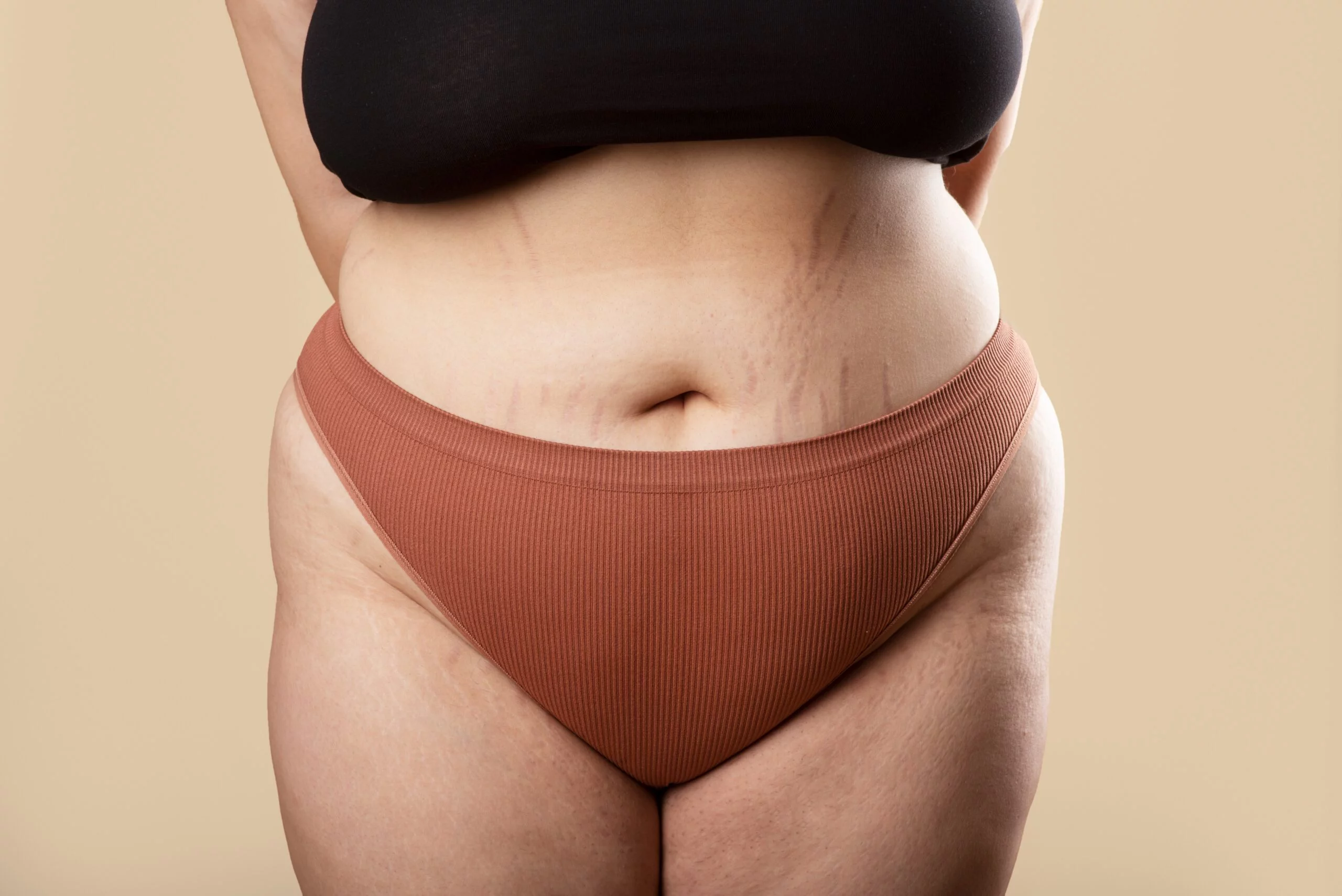 lipedema and hormones