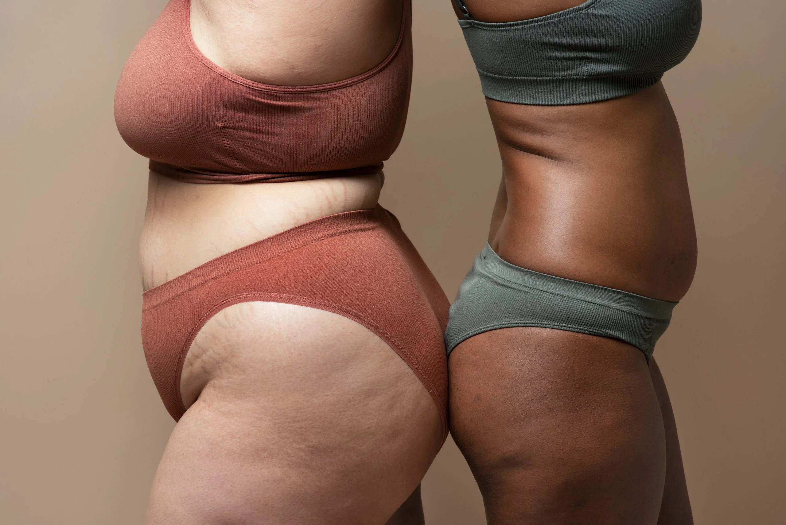 lipedema and hormones