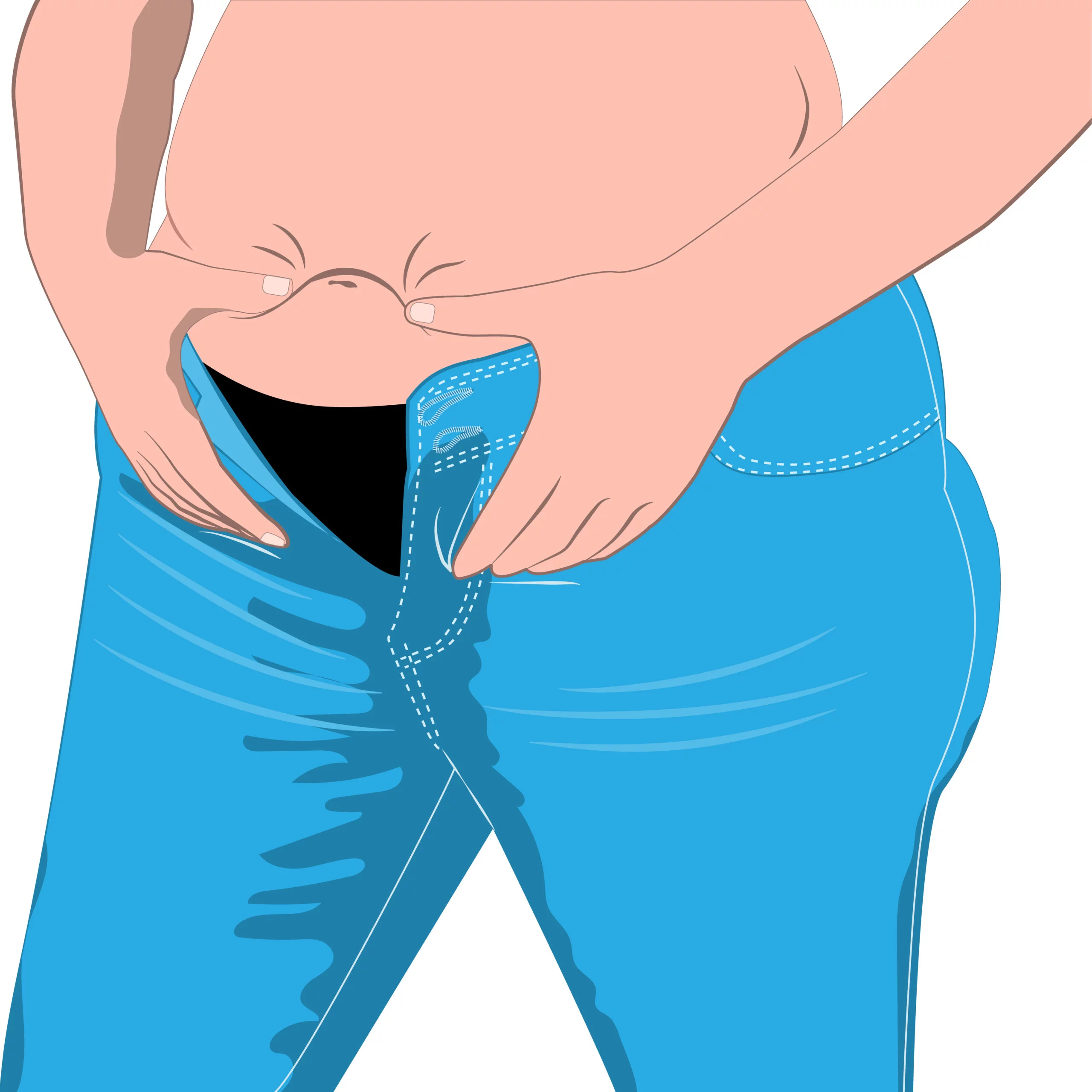 lipedema and hormones