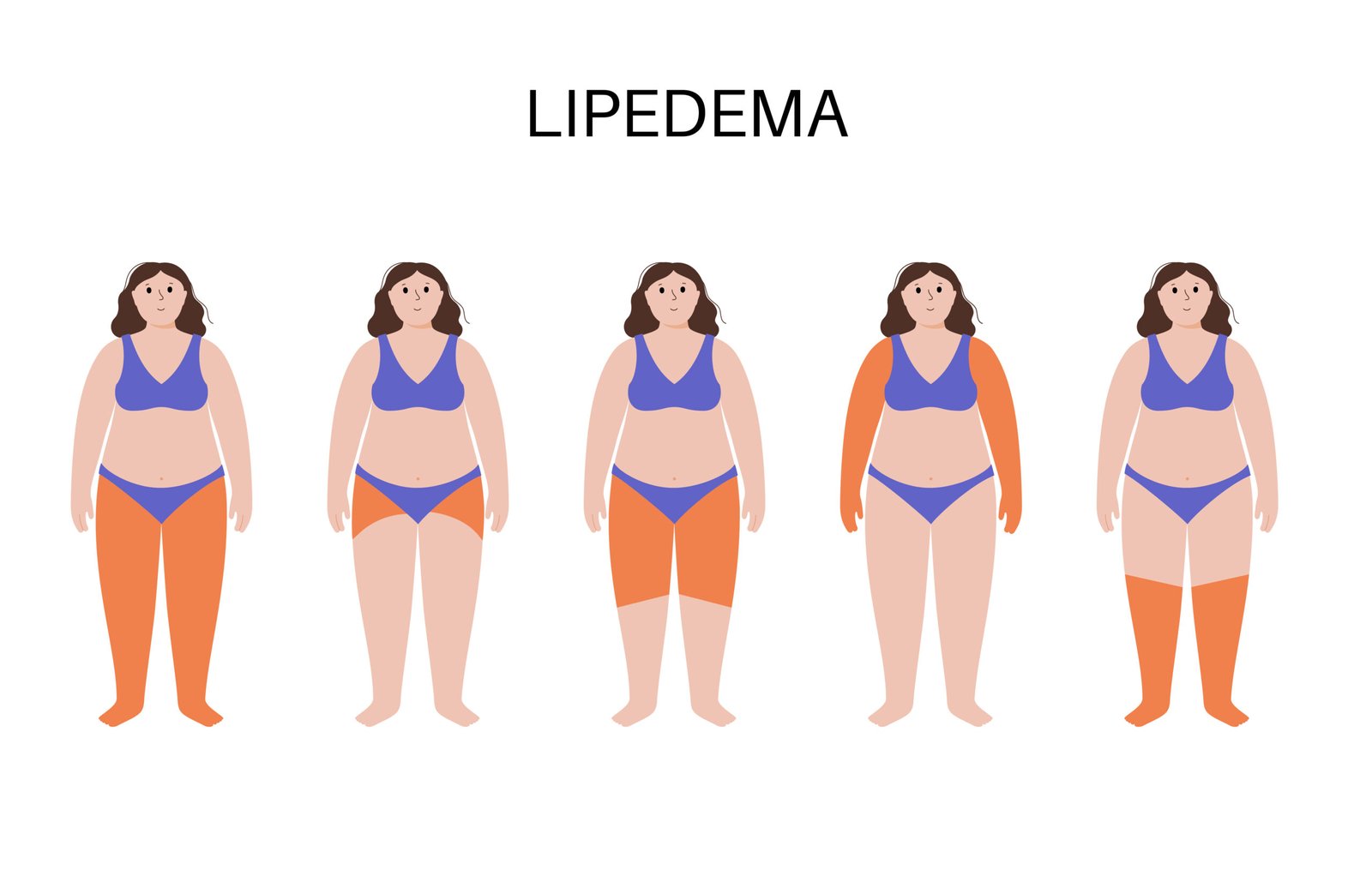 lipedema in different stages of life